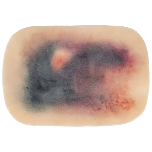 TraumaSim Self-Adhesive Large Haematoma