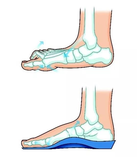 Talarmade Elevate - Dual Density, Heat Mouldable Modular Orthotic Kit for Customised Patient Fit
